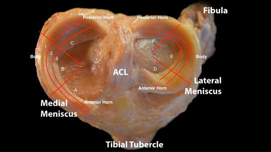 Image of ACL, Medial Meniscus, Lateral Meniscus