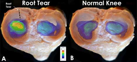 Diagram showing root tear versus normal knee