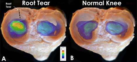 Diagram showing root tear versus normal knee