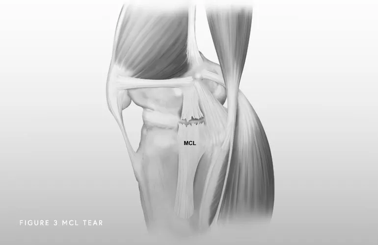 Image of MCL Tear
