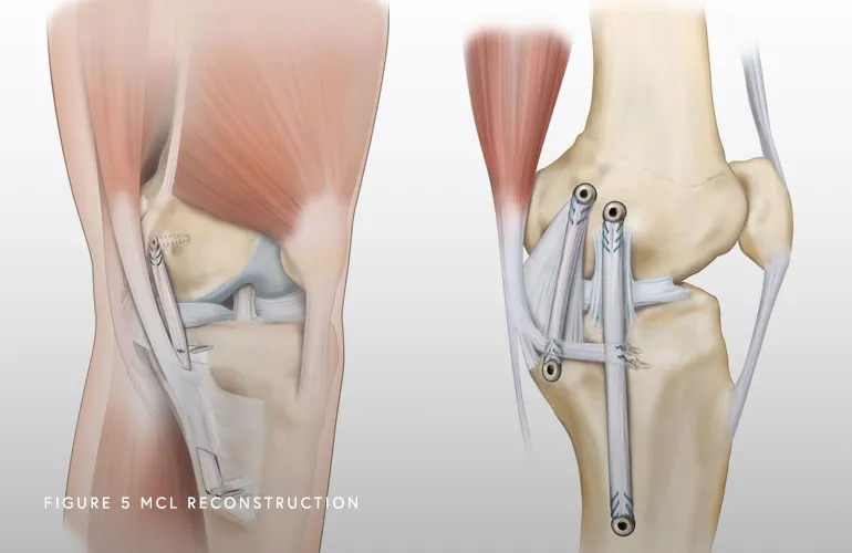 Image of MCL Reconstruction