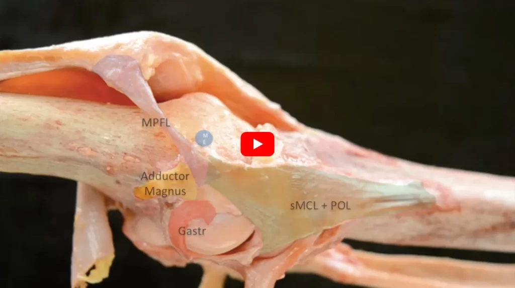 Medial Collateral Ligament Reconstruction Video